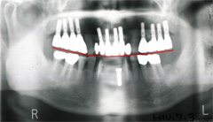 臼歯部の咬合平面を確定した状態